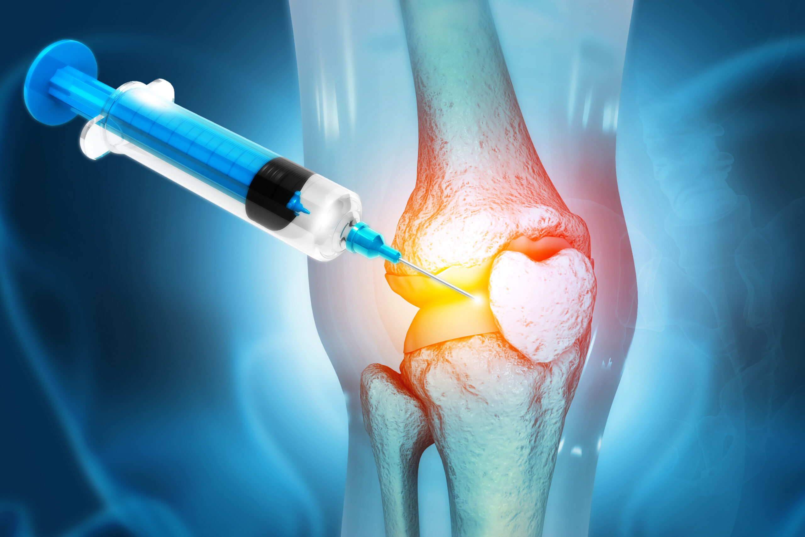 Anatomy Human Knee Joint Treatment, Osteoarthritis Injection, Drug Method Injection, knee injury, 3d illustration Joint & Muscular Injections
